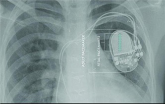 نخستین ضربان‌ساز قلب جنین در جهان