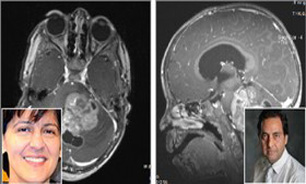 هدفگیری سرطان مغز کودکان با ترکیب دارویی محققان ایرانی