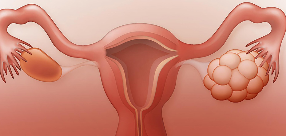 تخمدان پلی کیستیک و شیوع بالا در زنان ایرانی!